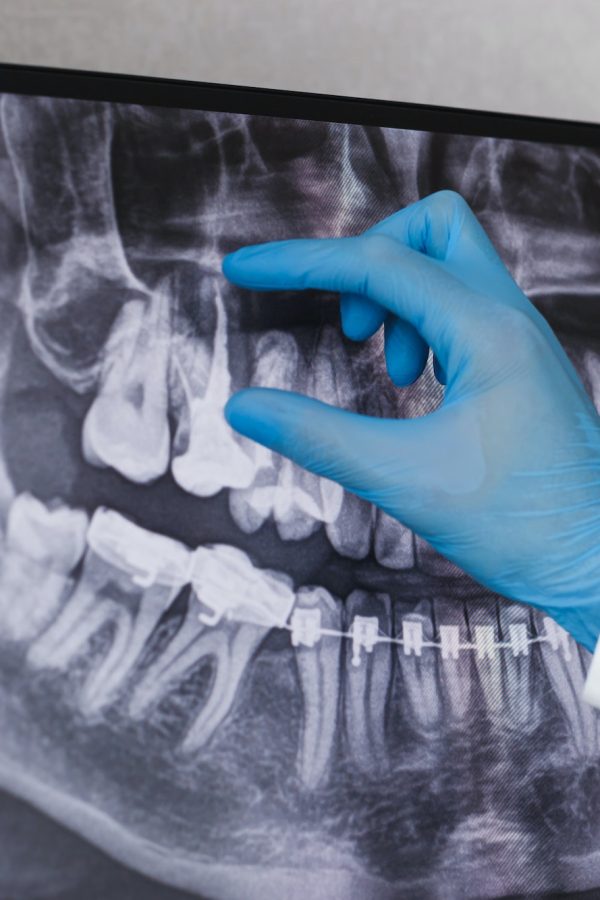 Doctor points to filled root canal in dental x-ray